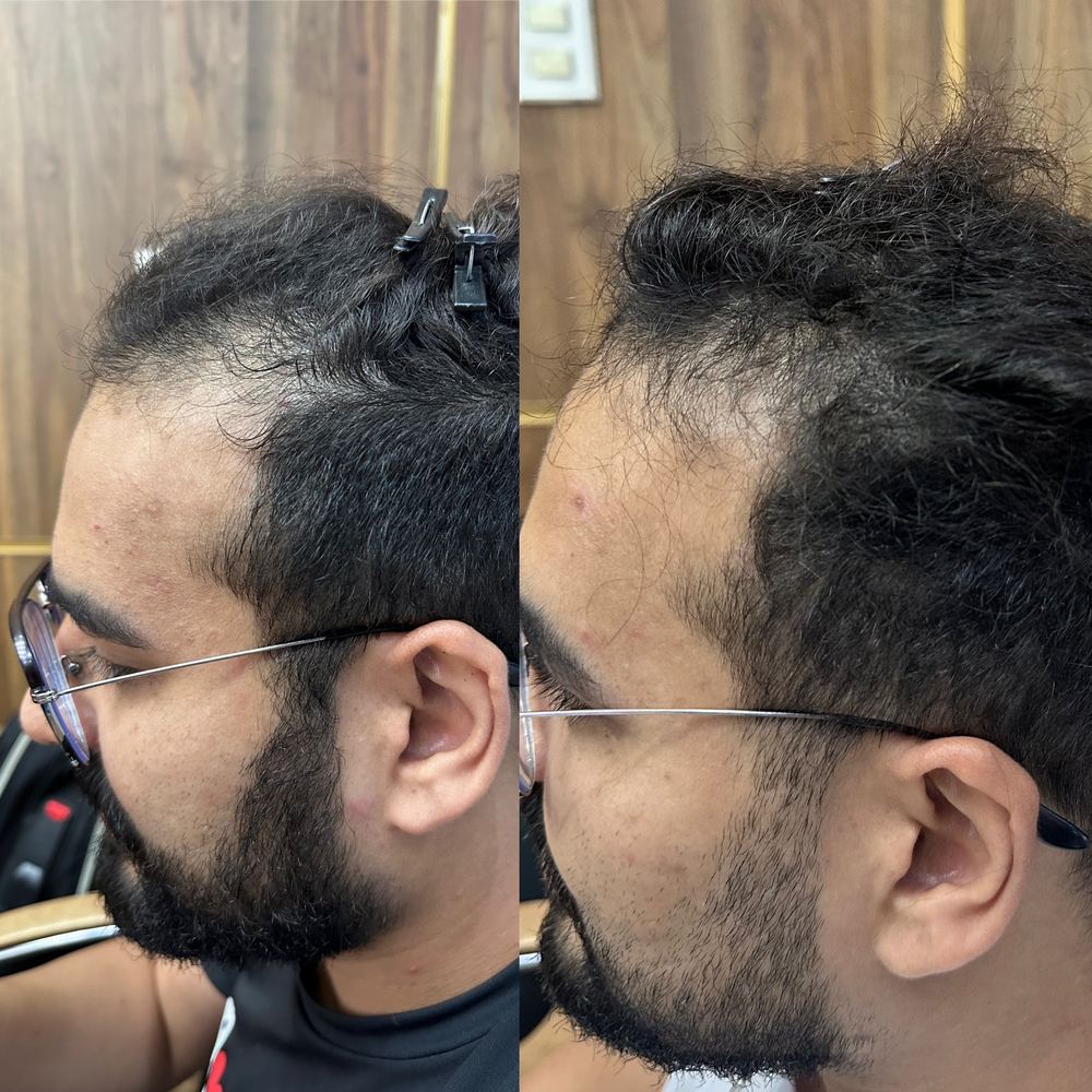 Antes e depois - Calvície grau 3 — 2.500 folículos — 12 meses de resultado