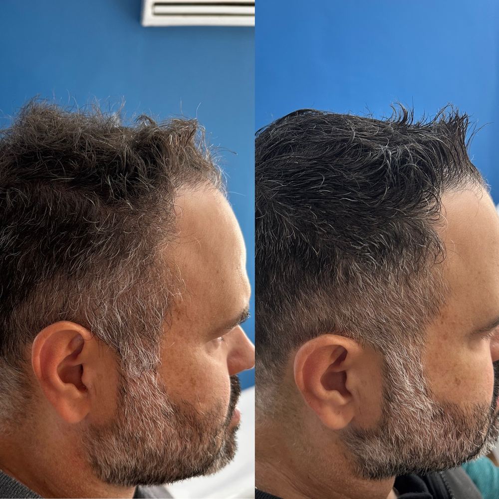 Antes e depois - Calvície grau 4 — 3.000 folículos — 14 meses de resultado