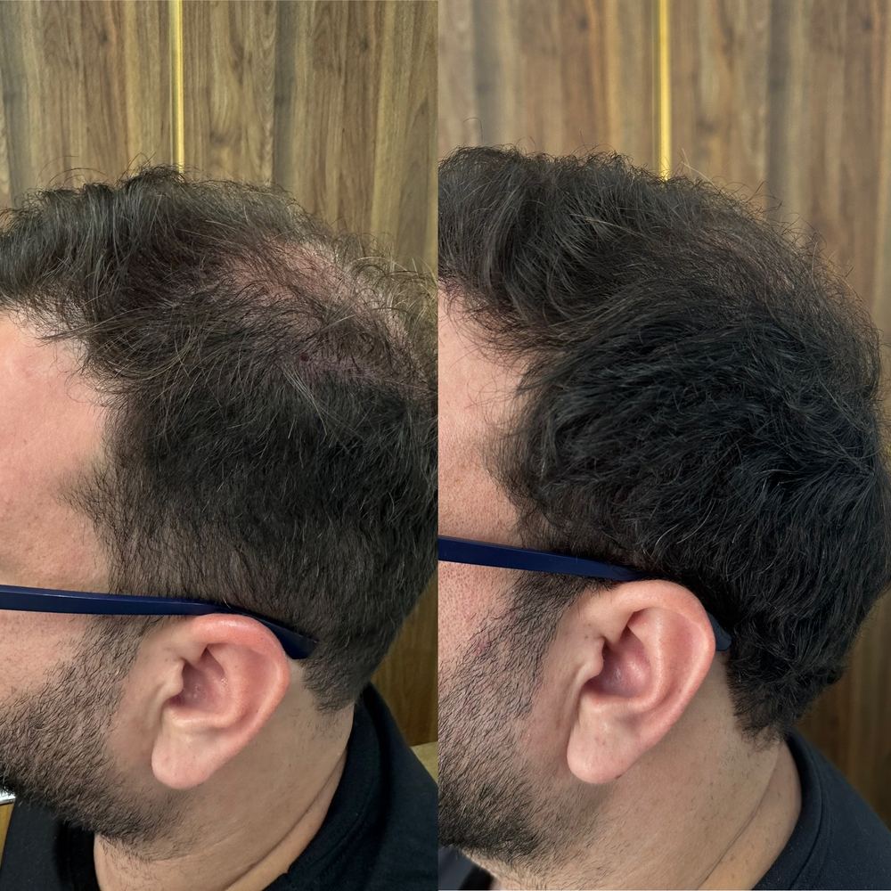 Antes e depois - Entradas avançadas — 2.000 folículos — 10 meses de resultado